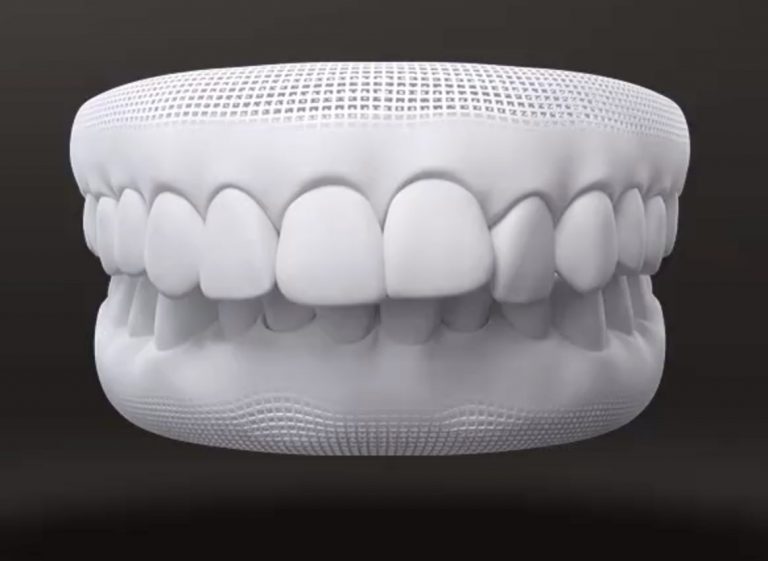 3D-Modell zeigt Tiefbiss