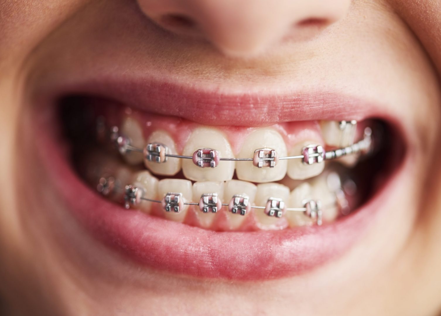 Lockeres Bracket bei Zahnspange – typisches Problem im Alltag