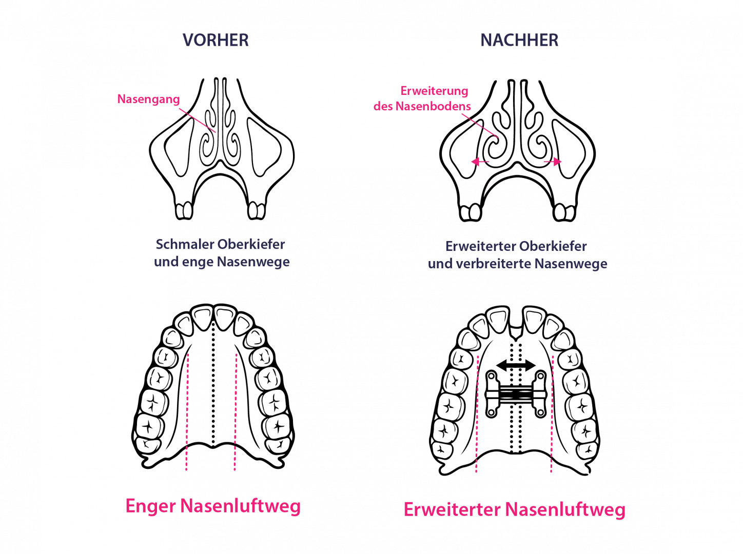 DOME und Gaumennahterweiterung beim Erwachsenen: Grafik zur Oberkieferverbreiterung, Erweiterung der Atemwege und Behandlung eines schmalen Oberkiefers.