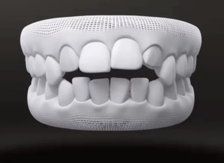 3D-Modell eines Kiefers mit offenem Biss. Zwischen den oberen und unteren Frontzähnen bleibt beim Zusammenbeißen eine Lücke.