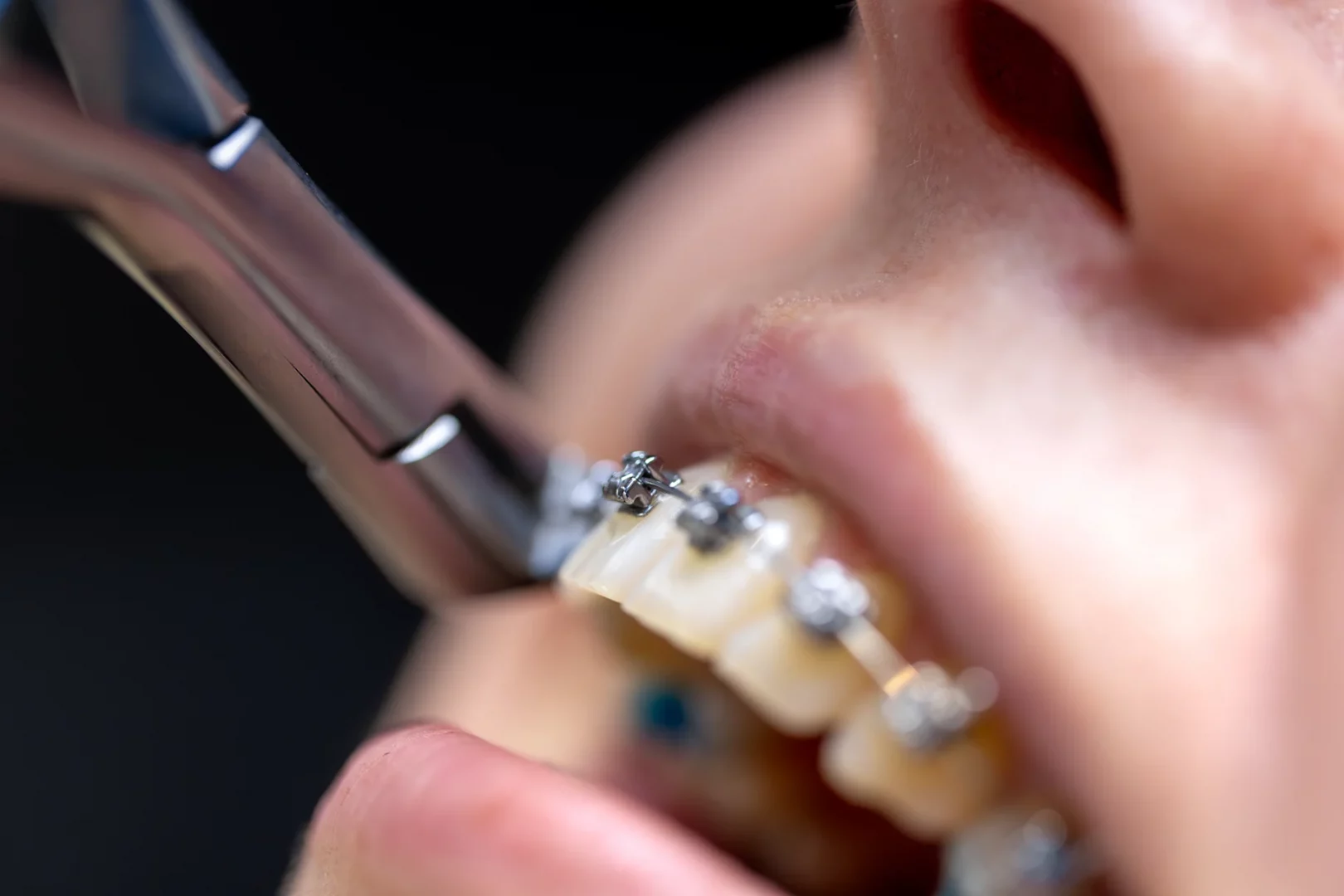 Nahaufnahme einer festen Zahnspange mit Metallbrackets