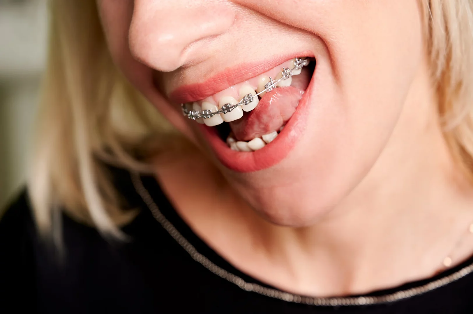 Nahaufnahme einer festen Zahnspange mit Metallbrackets auf den Zähnen während einer kieferorthopädischen Behandlung.