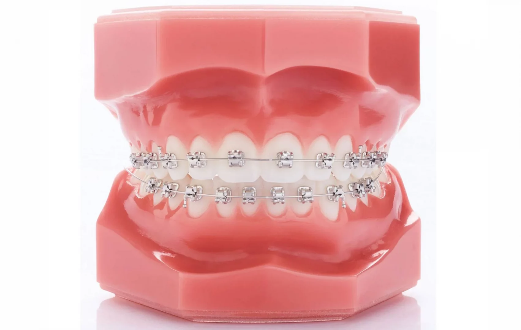 3D-Zahnmodell mit selbstligierenden Brackets zur Darstellung einer modernen festen Zahnspange.