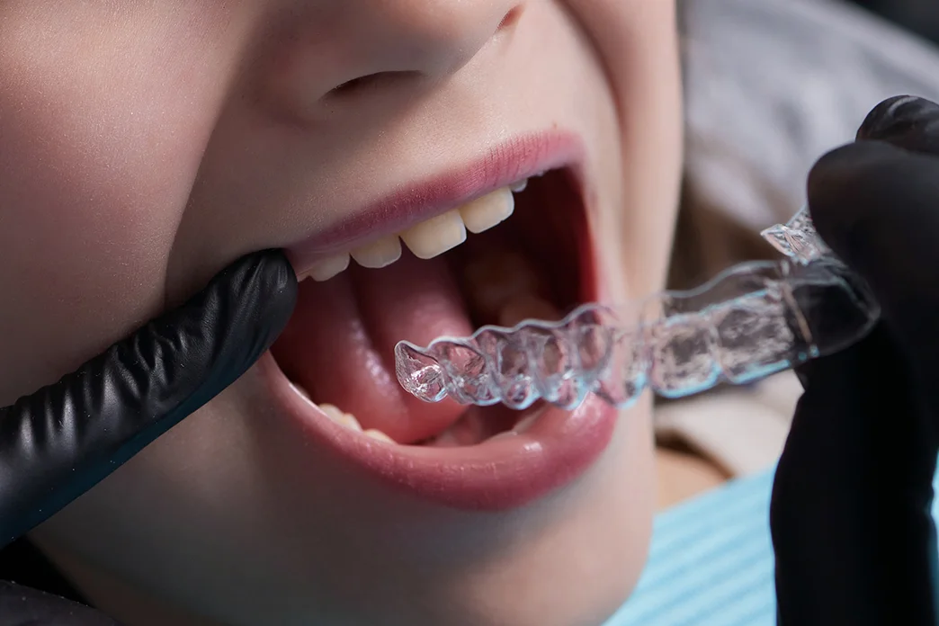 Einsetzen-Invisalign-Zahnschiene-bei-einem Mädchen